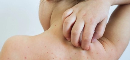 Елімізде 66 науқас қызылша дертіне шалдықты