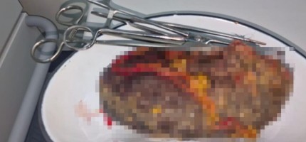 10 жасар баланың асқазанынан бір келіге жуық шаш шықты