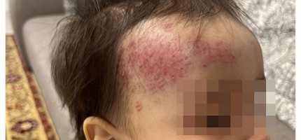 Балабақшада зардап шеккен баланың анасы мекеме басшысына сенбейді