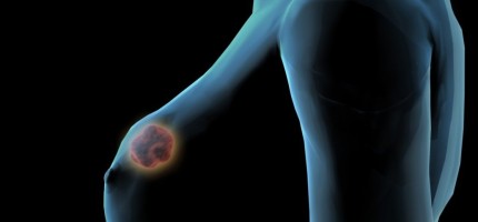 Сүт безі қатерлі ісігін енді қарапайым қан талдауымен анықтай алады