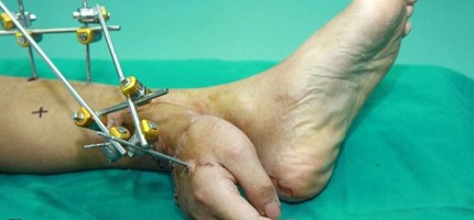 Қытайлық дәрігерлер науқастың жұлынып кеткен қолын оның аяғына тігіп, өмірін сақтап қалды